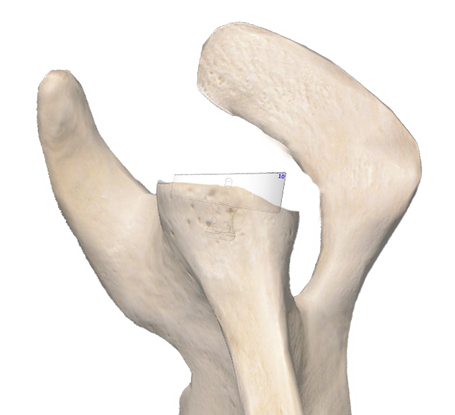 augmented glenoid backside support
