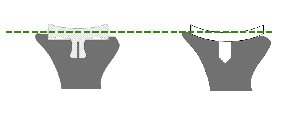 InSet vs Onlay post ream