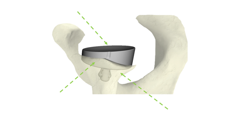 Augmented Glenoid - InSet™ Plus from Shoulder Innovations