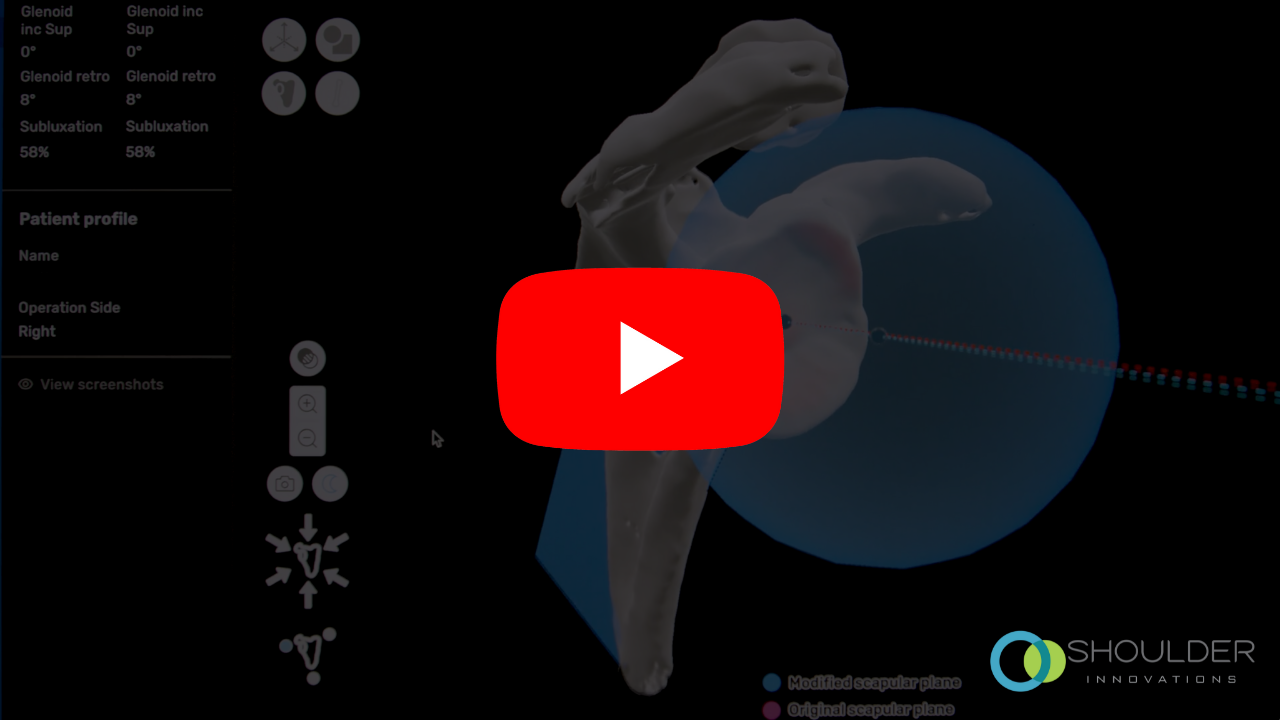 shoulder replacement surgery video
