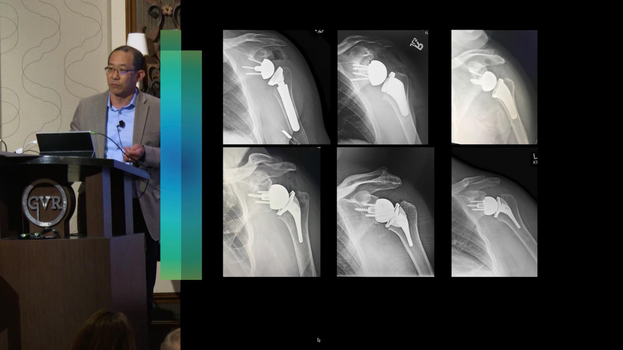 Dr. Kam reverse shoulder video