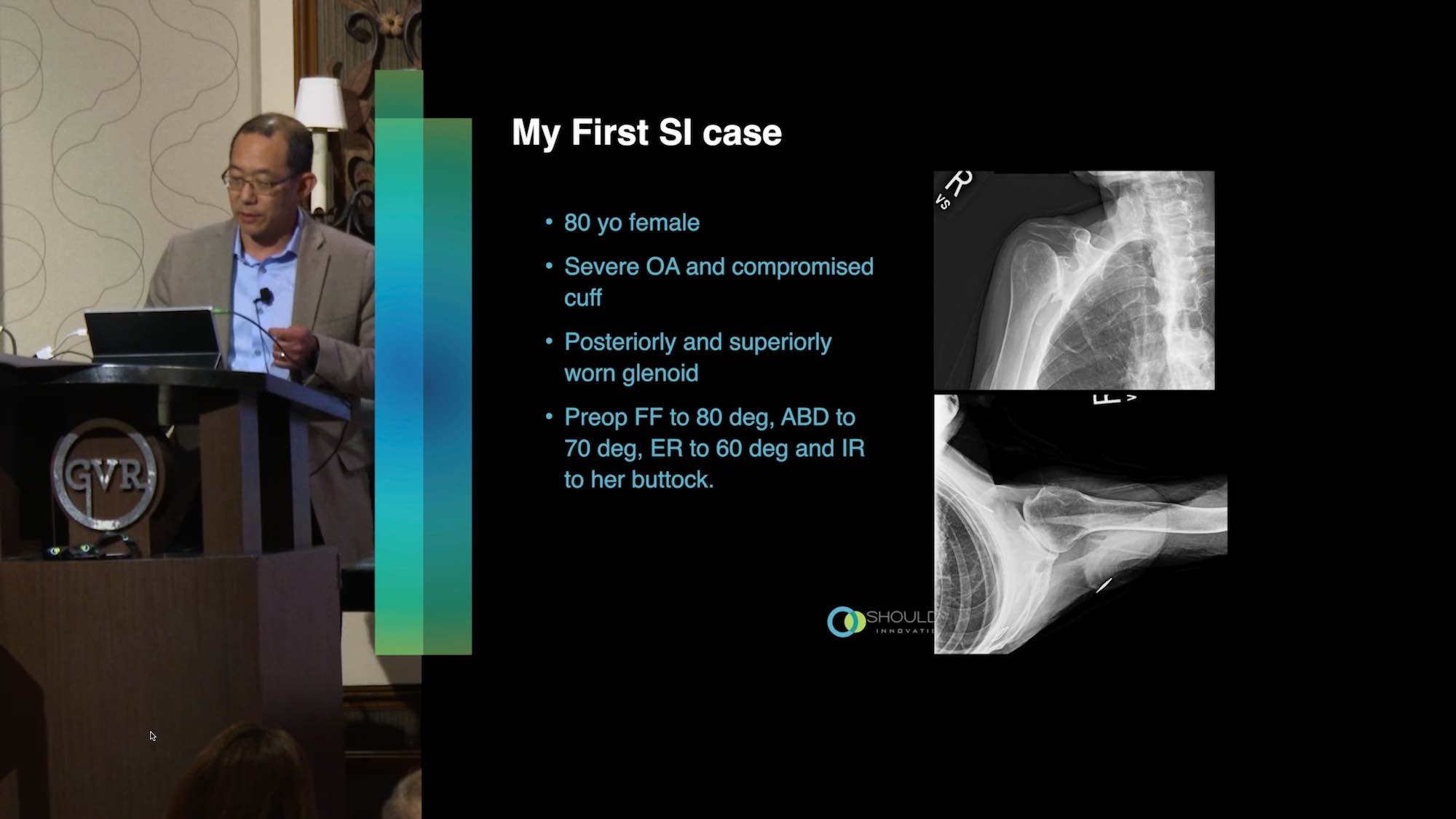 Dr. Kam reverse shoulder video presentation