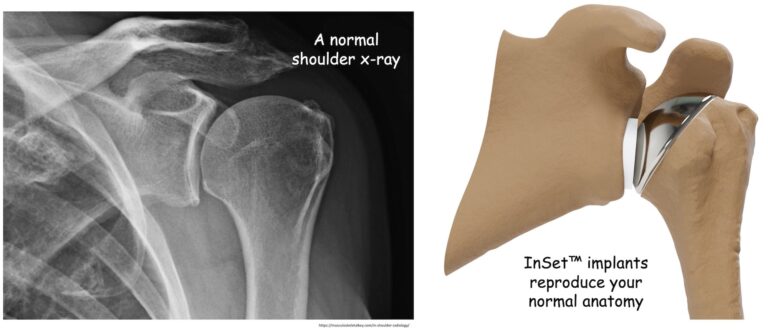 Anatomic shoulder replacement xray and InSet™ implant