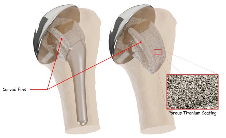 Curved fins of InSet™ shoulder implant