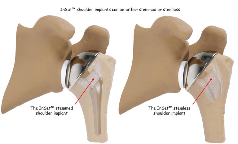 InSet™ Stem vs Stemless shoulder implant