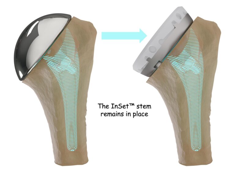 InSet™ humeral stem anatomic and reverse