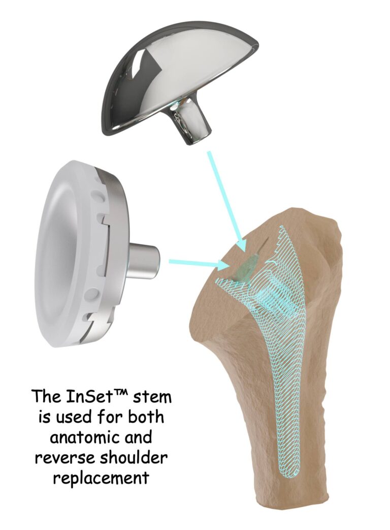 InSet™ humeral stem for anatomic and reverse shoulder replacement