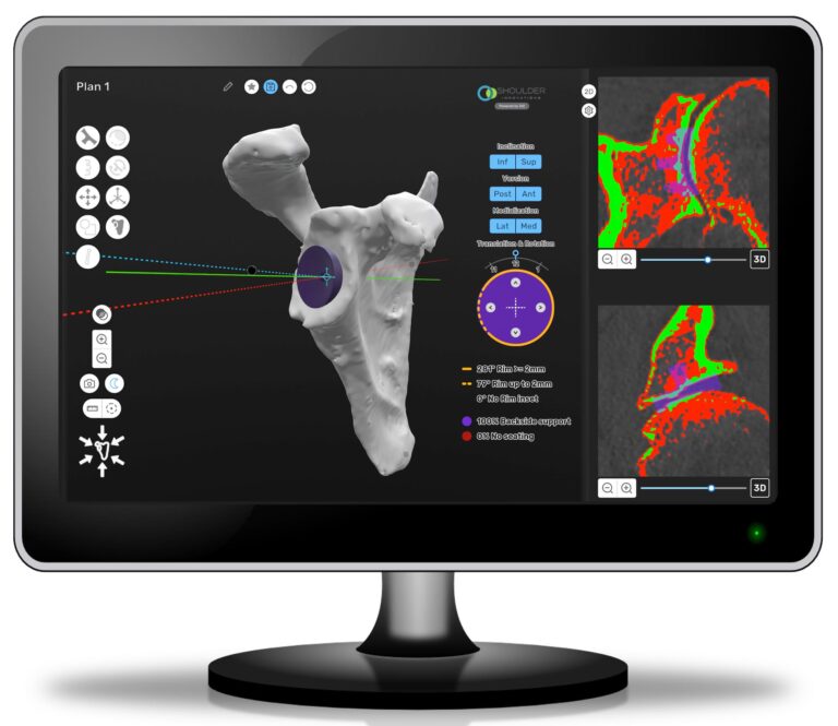 Planning glenoid implant with software