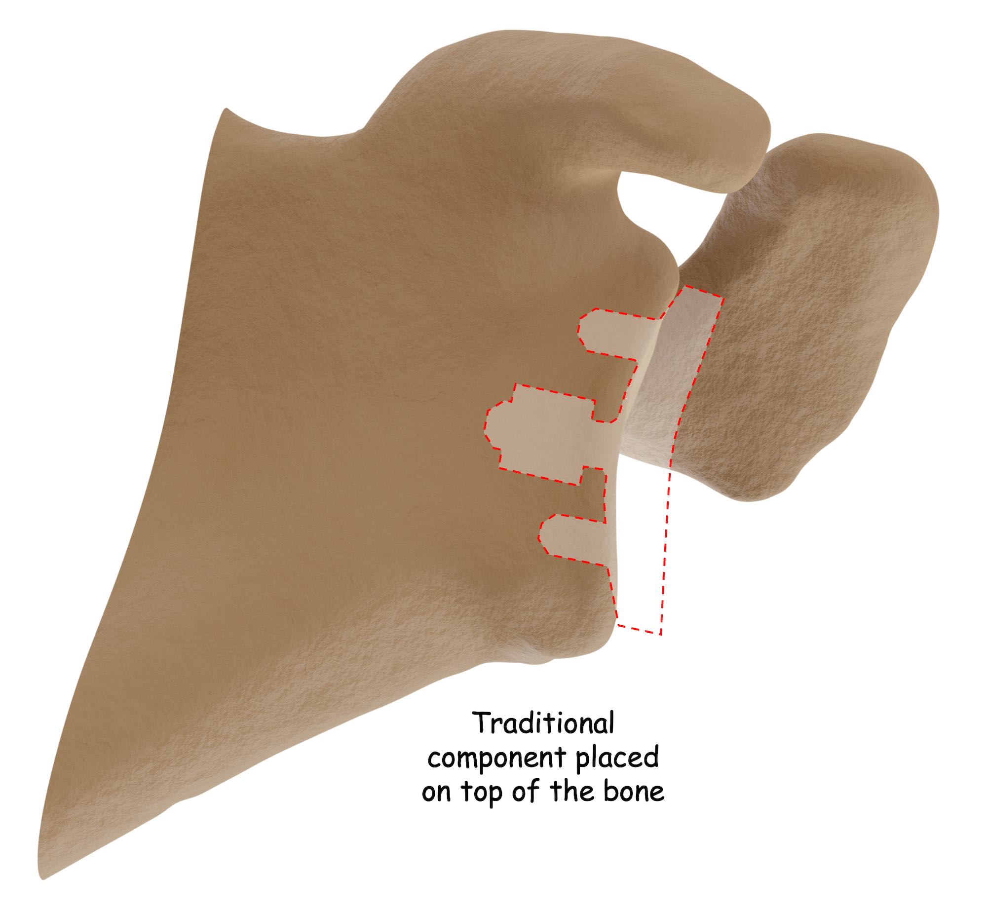 Traditional glenoid implant
