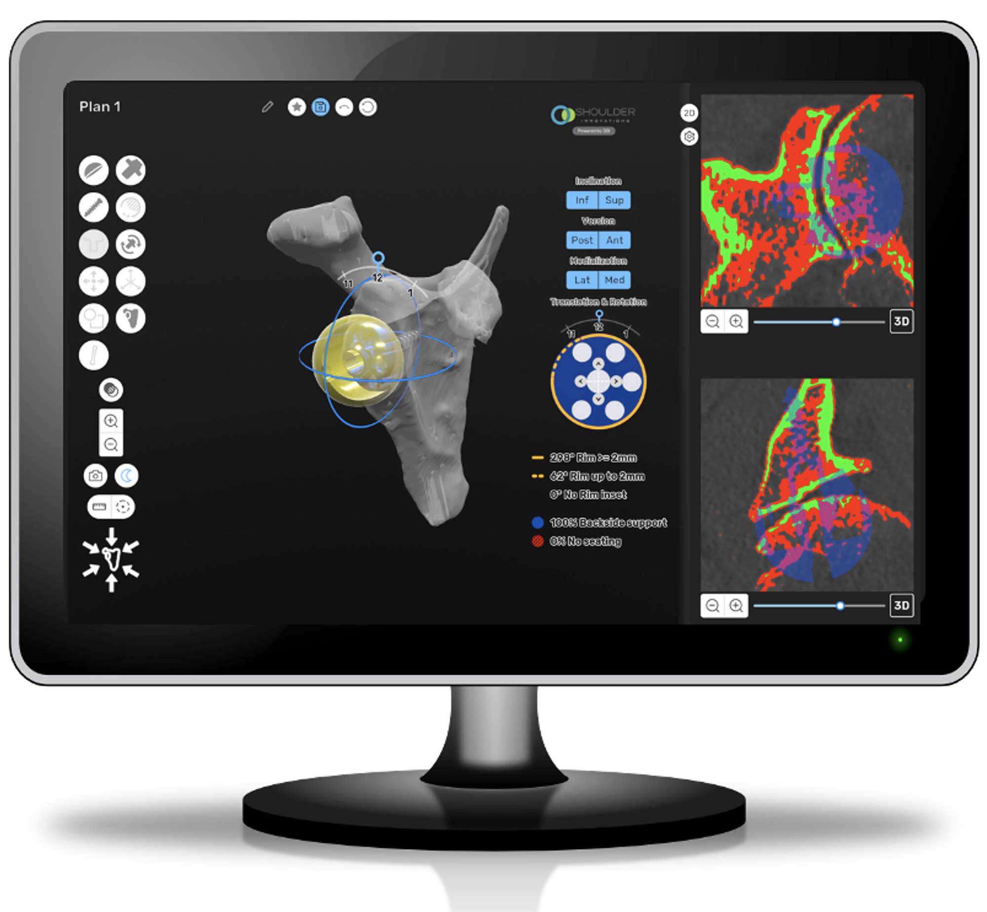 3D orthopedic planning software for reverse shoulder replacement