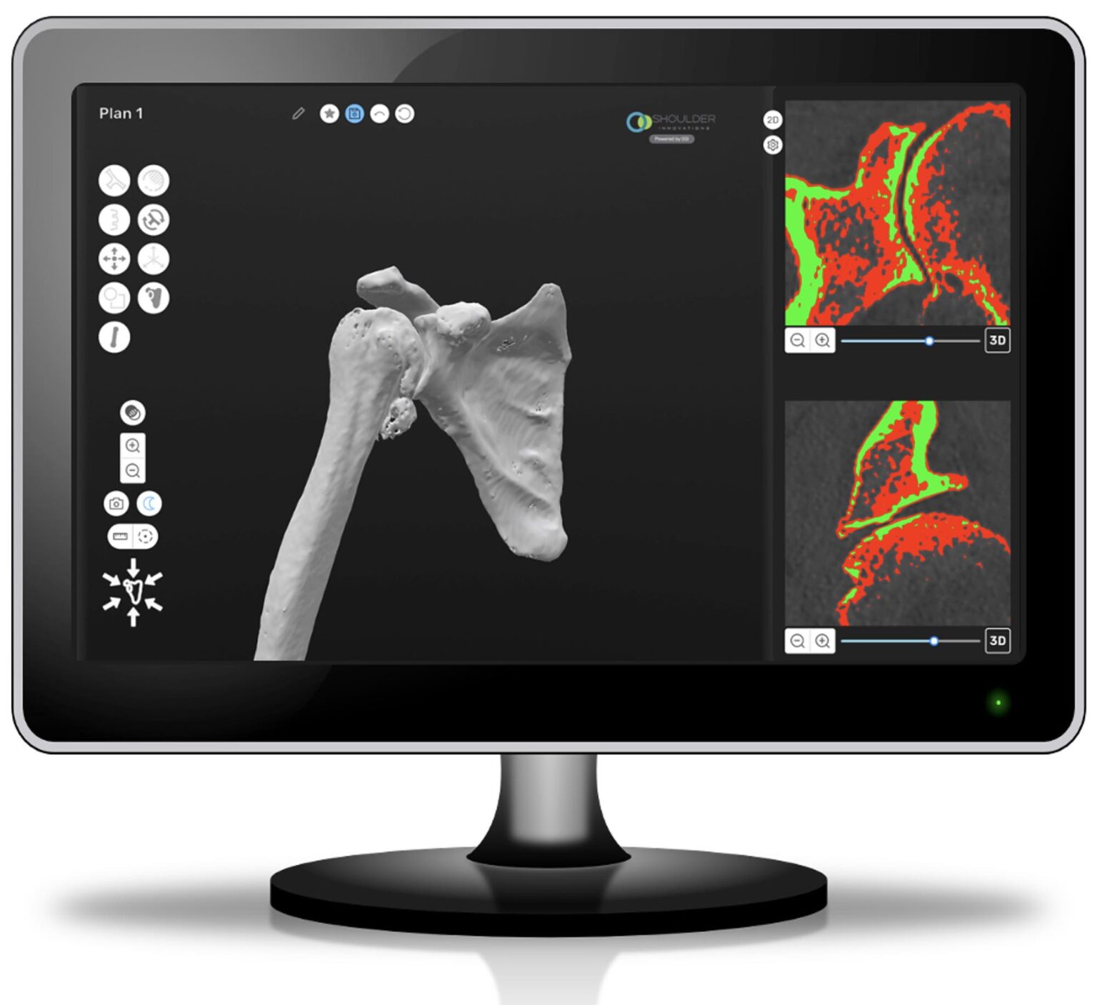 Reverse Shoulder Replacement - Shoulder Innovations