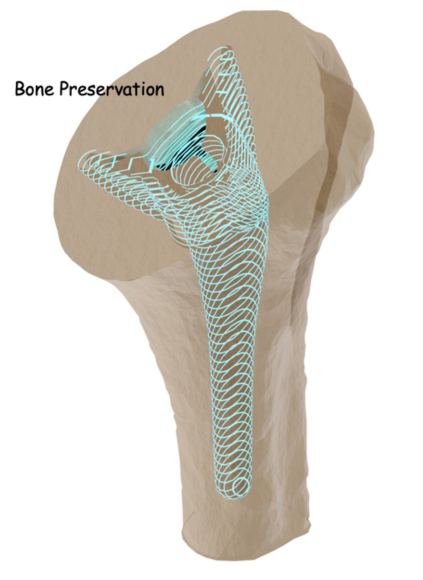 Reverse shoulder replacement surgery bone preservation with InSet™ humeral stem