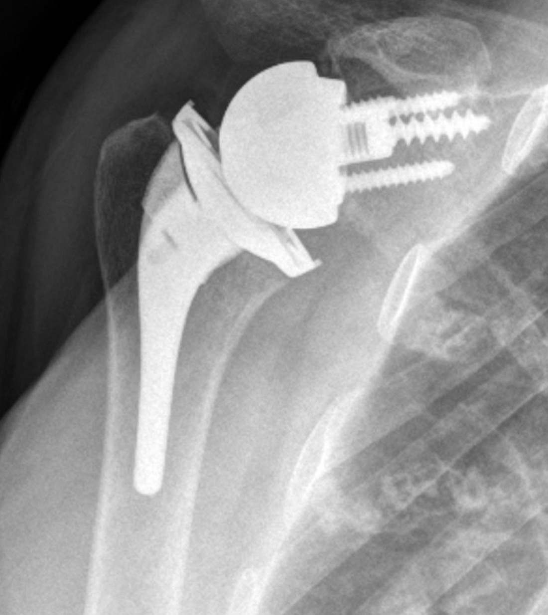 X-ray of reverse shoulder implant 2