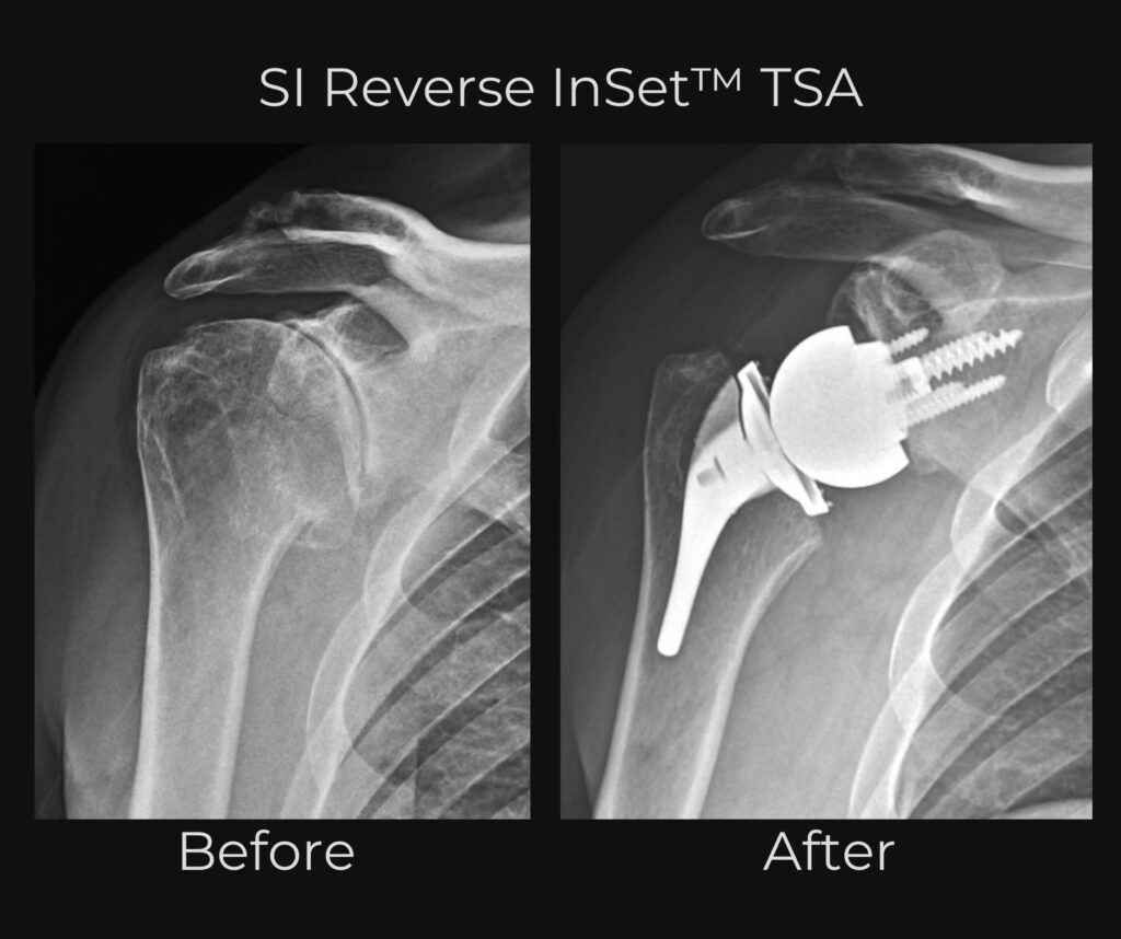 Before and after x-rays from Dr. Ryan Churchill using an InSet™ reverse shoulder implant
