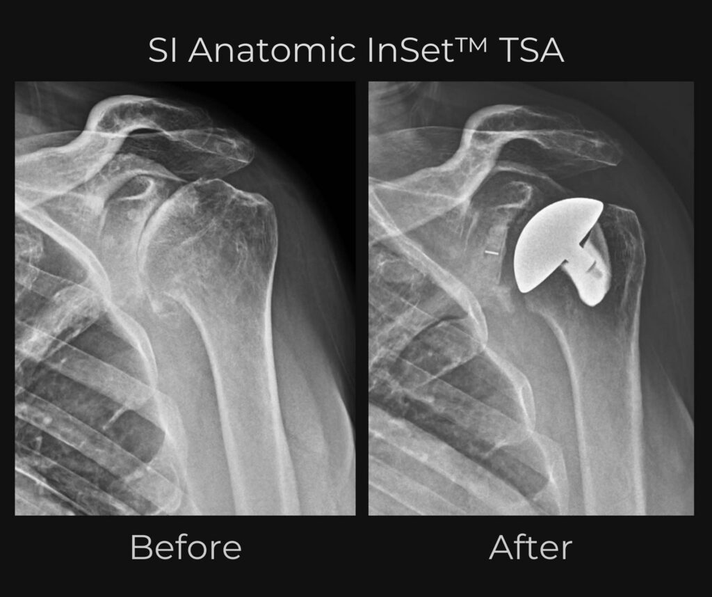 Before and after x-rays from Dr. Ryan Churchill using an InSet™ total shoulder implant