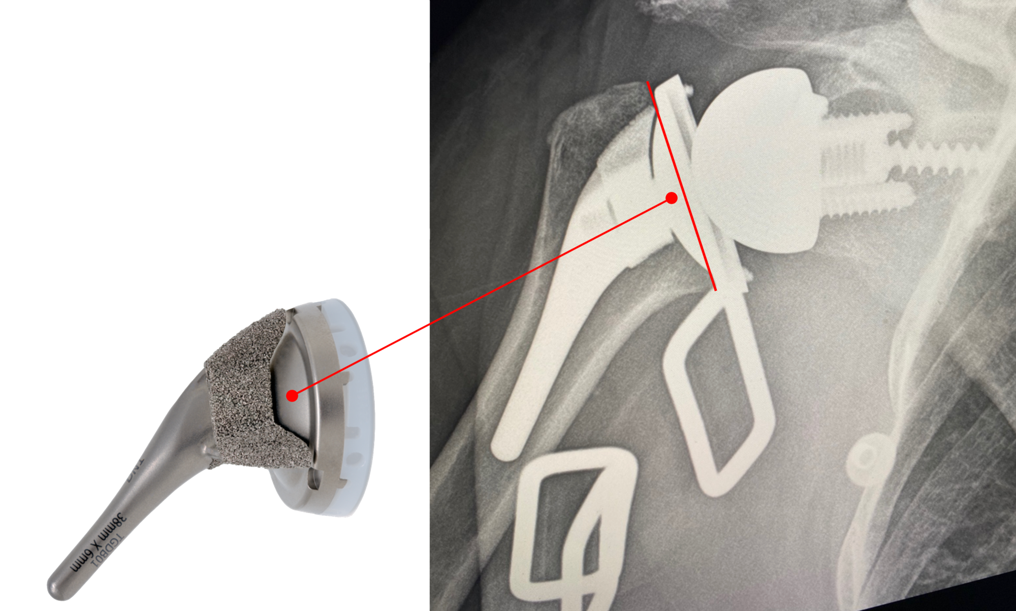 The InSet™ Bowl is placed within the metaphysis