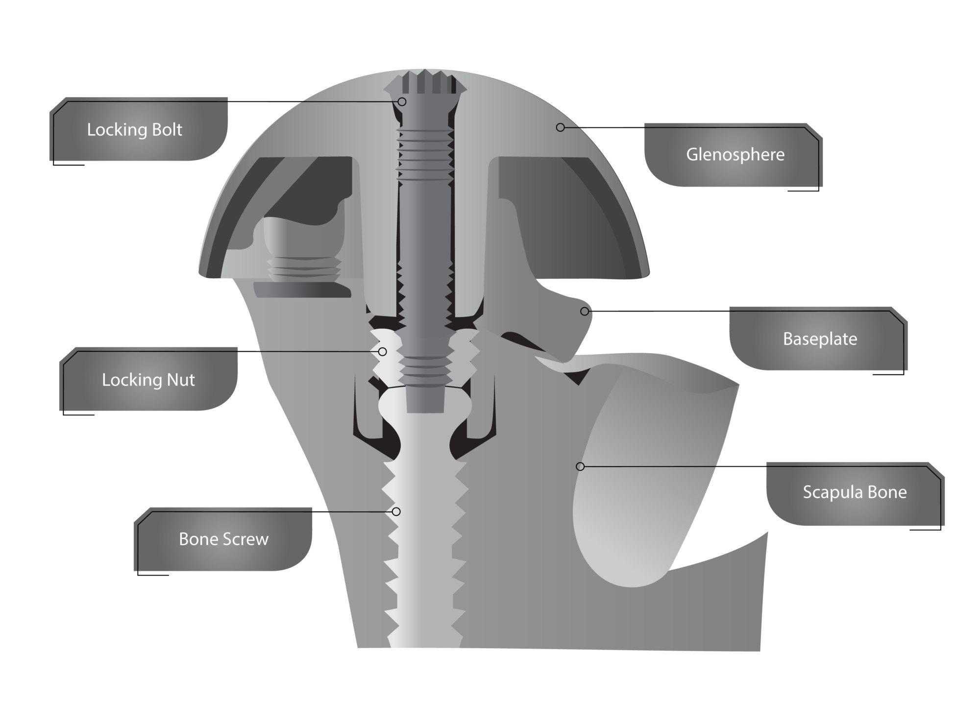 Reverse shoulder patent for Shoulder Innovations 