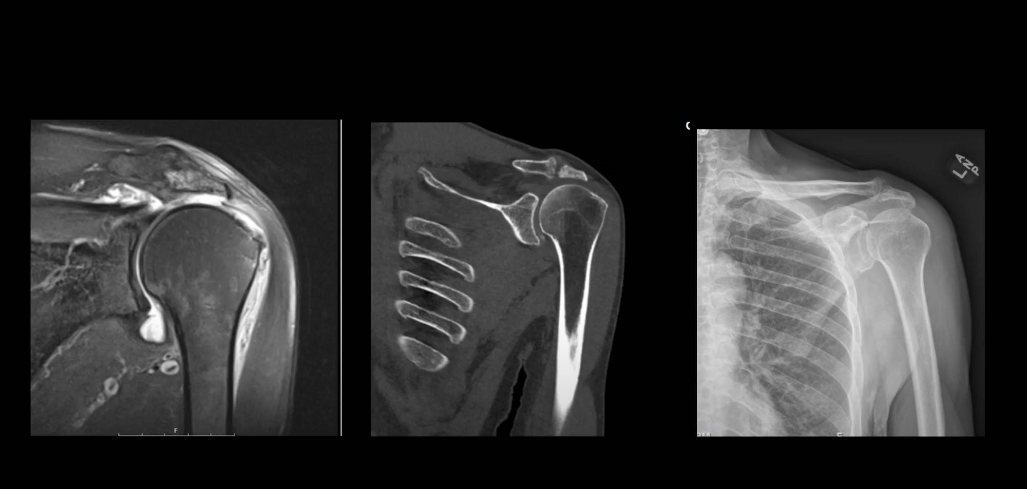 X-ray and CT from reverse shoulder patient