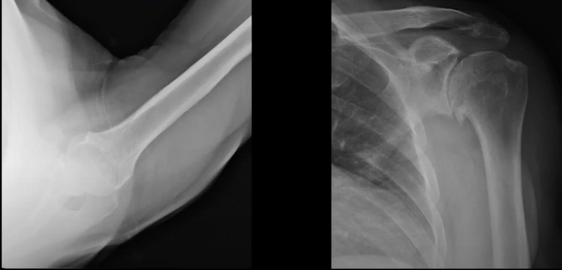 Preop x-rays from a stemless shoulder replacement surgery performed by Dr. John Macy