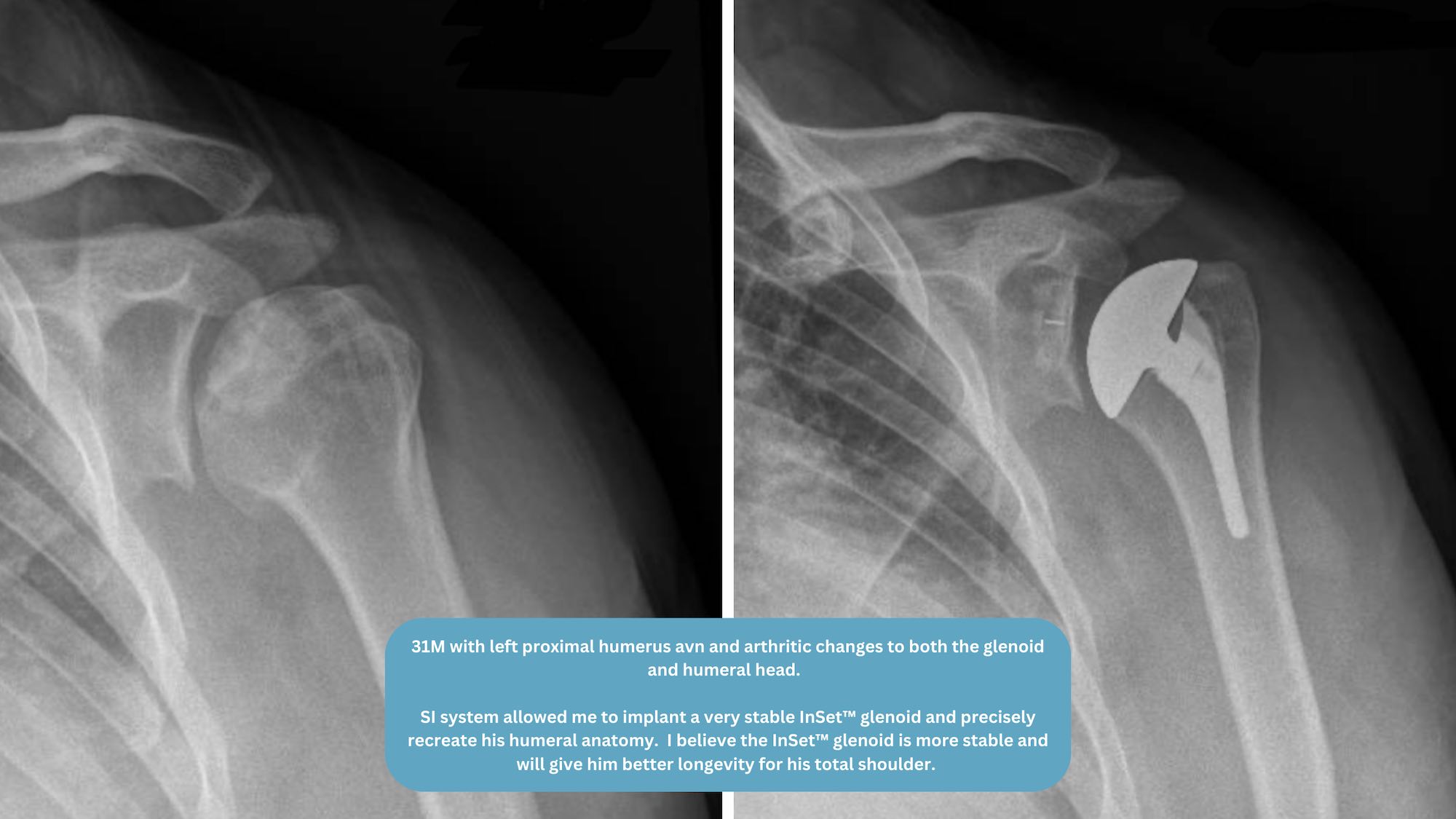 Dr. Orvets Total Shoulder Replacement