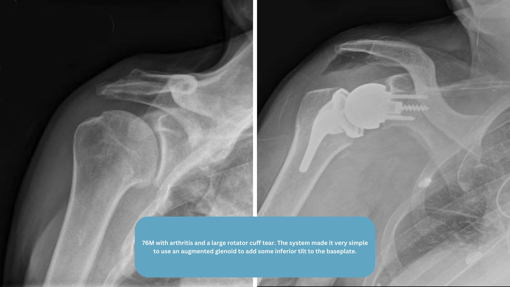 Dr. Orvets Reverse Shoulder Replacement