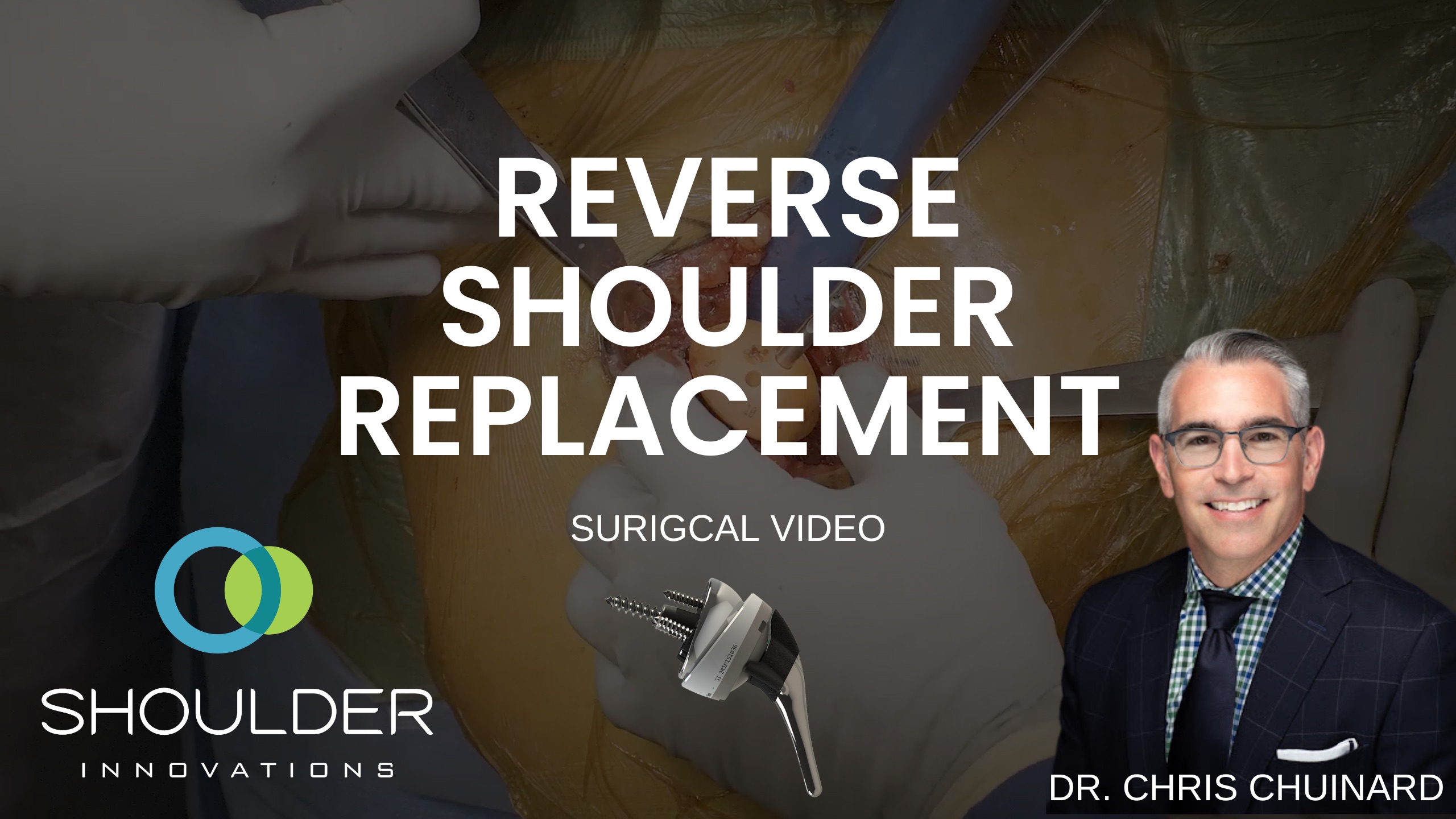Dr. Chris Chuinard Reverse Shoulder Replacement Surgery Video