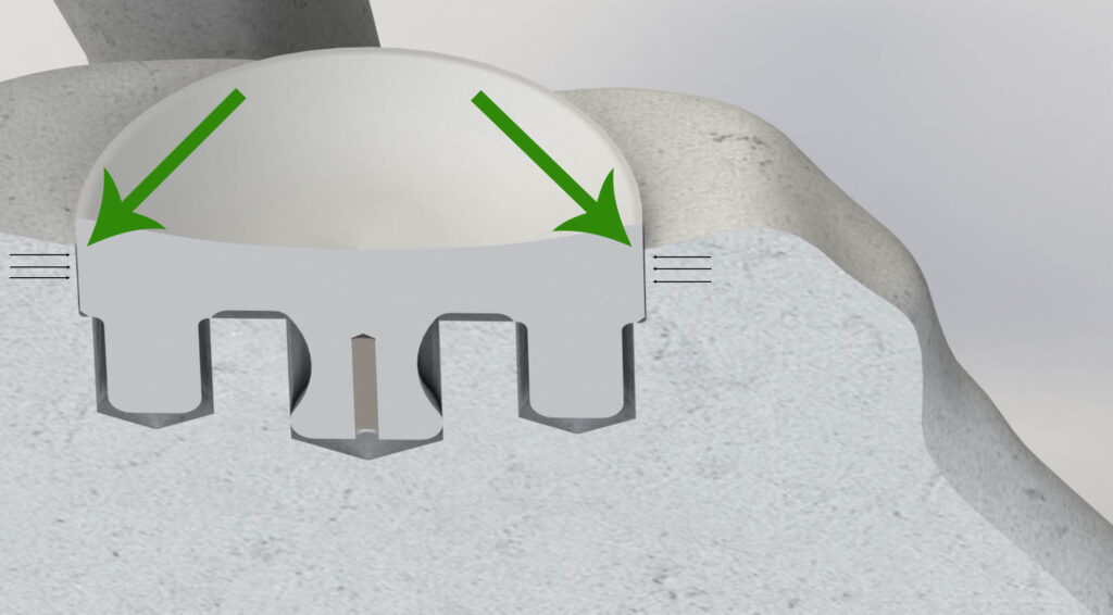 The InSet™ glenoid significantly reduces the stress that contributes to glenoid loosening