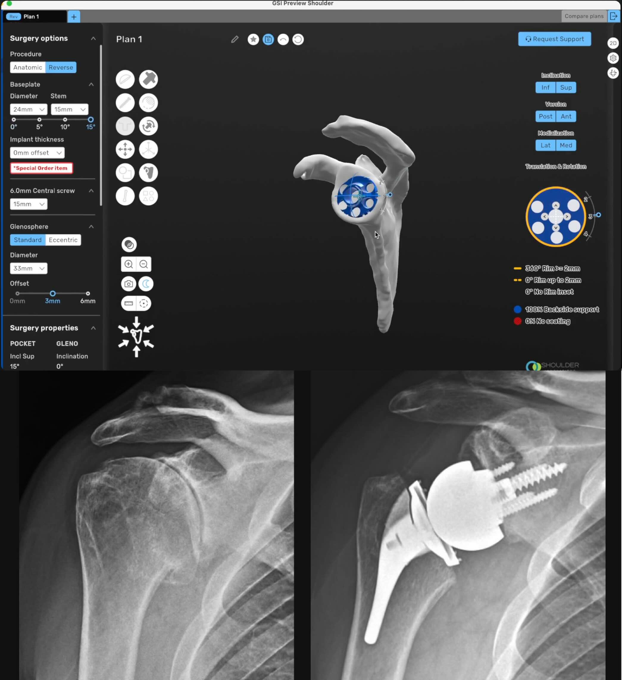 Pre Operative Planning software for a reverse shoulder surgery and x-rays of before and after of reverse surgery.