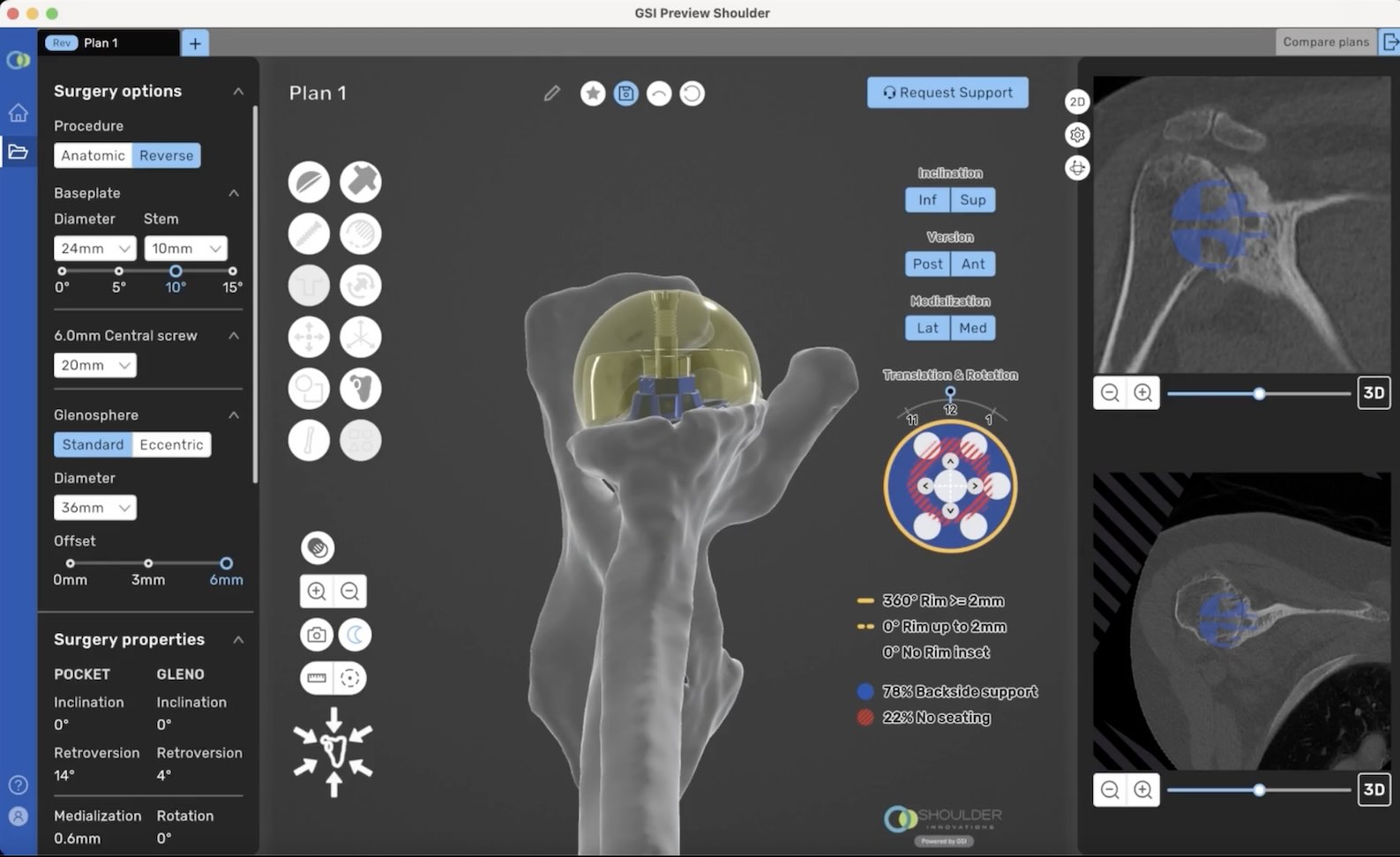 3D orthopedic planning software for reverse shoulder replacement. Seamless Integration with InSet™ Shoulder Implant System.