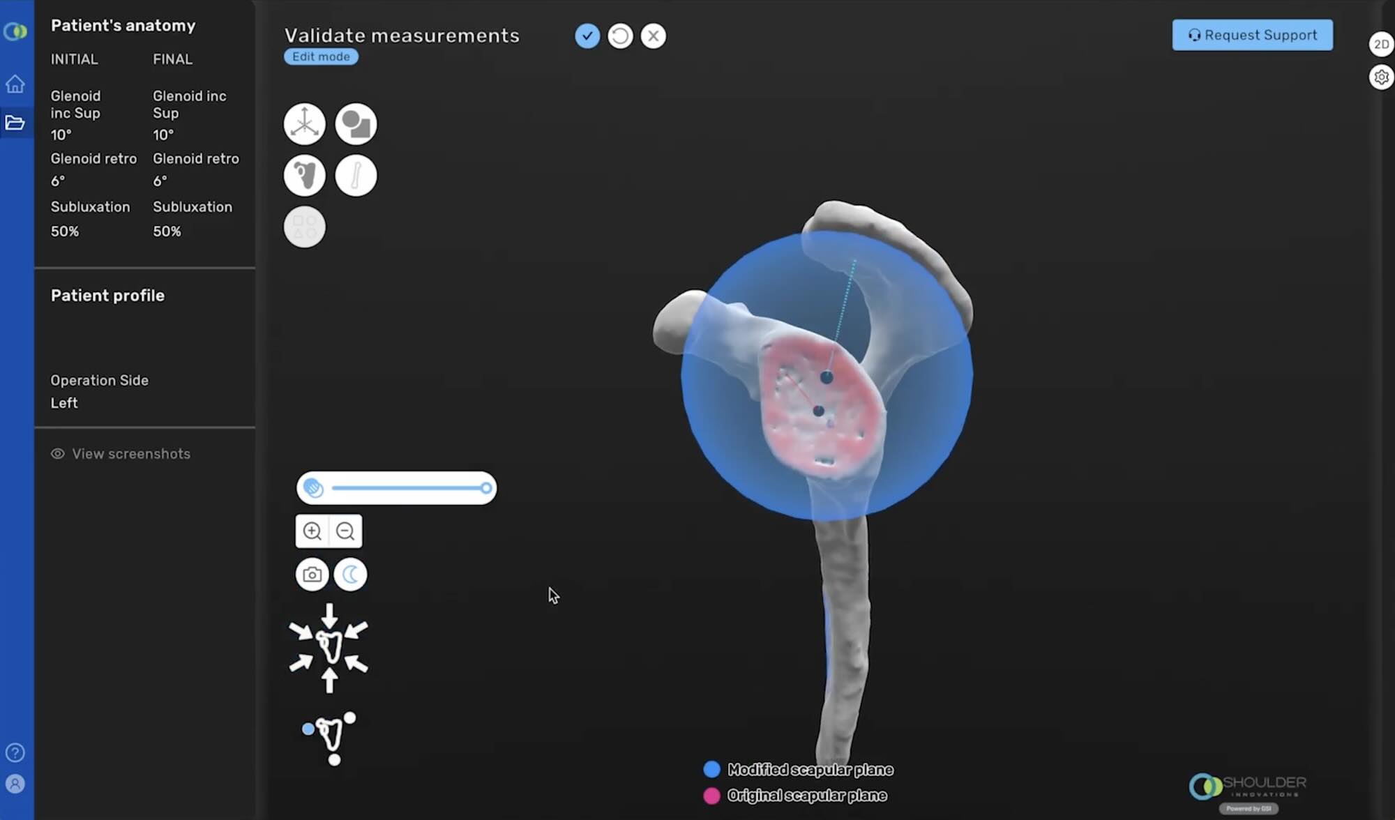 Shoulder Innovations | InSet™ Shoulder Implants