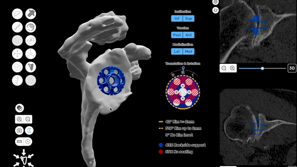 ProVoyance Pre-Operative Planning a Reverse Shoulder Arthroplasty