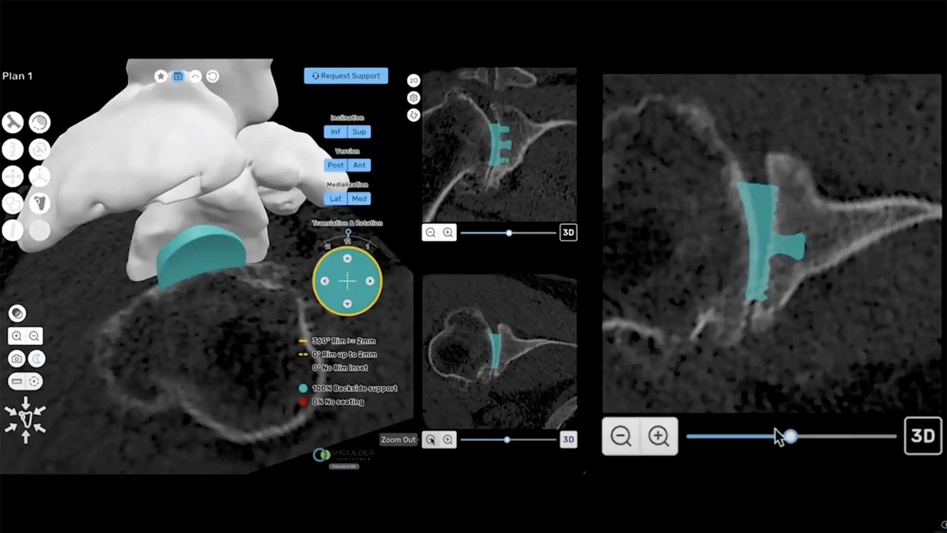 ProVoyance Shoulder Surgical Planning Software