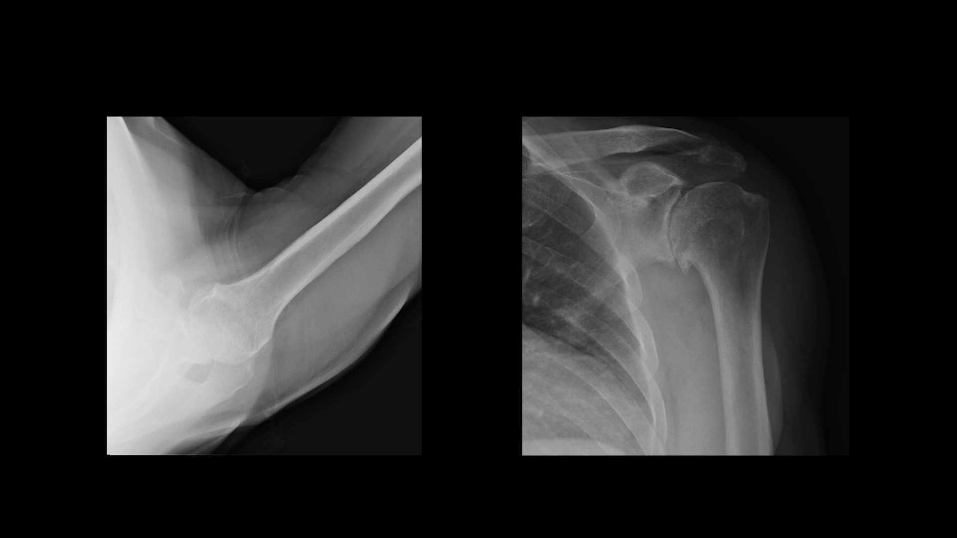 Stemless Shoulder Replacement with InSet™ Glenoid Technology (Short) - Dr. John Macy